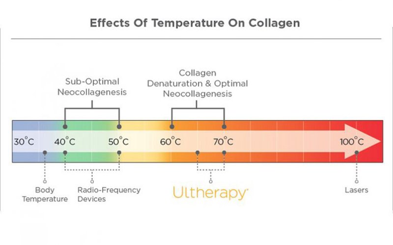 Ultherapy tác động nhiệt đến hệ thống Collagen đem đến hiệu quả trẻ hóa da mạnh mẽ. 
