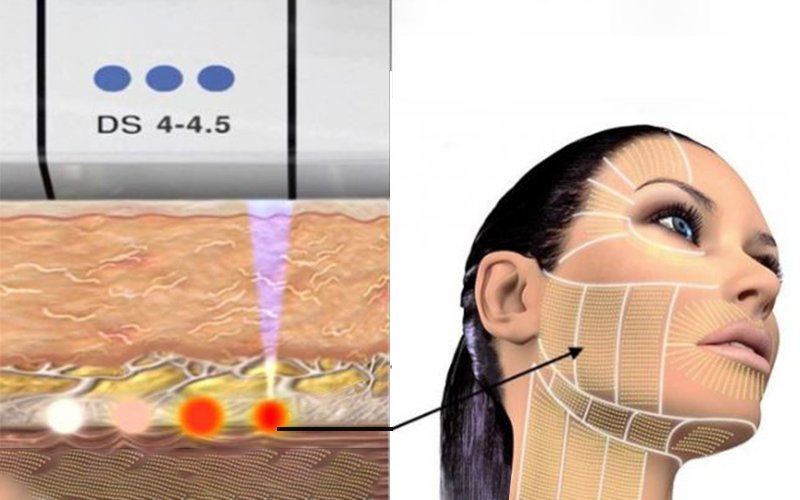 Công nghệ trẻ hóa làn da với máy Ultherapy